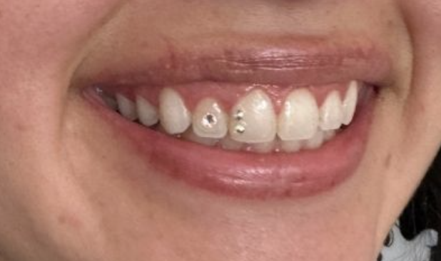 Bad Teeth Gems® Los Angeles Tooth Gems + Whitenings photo 3