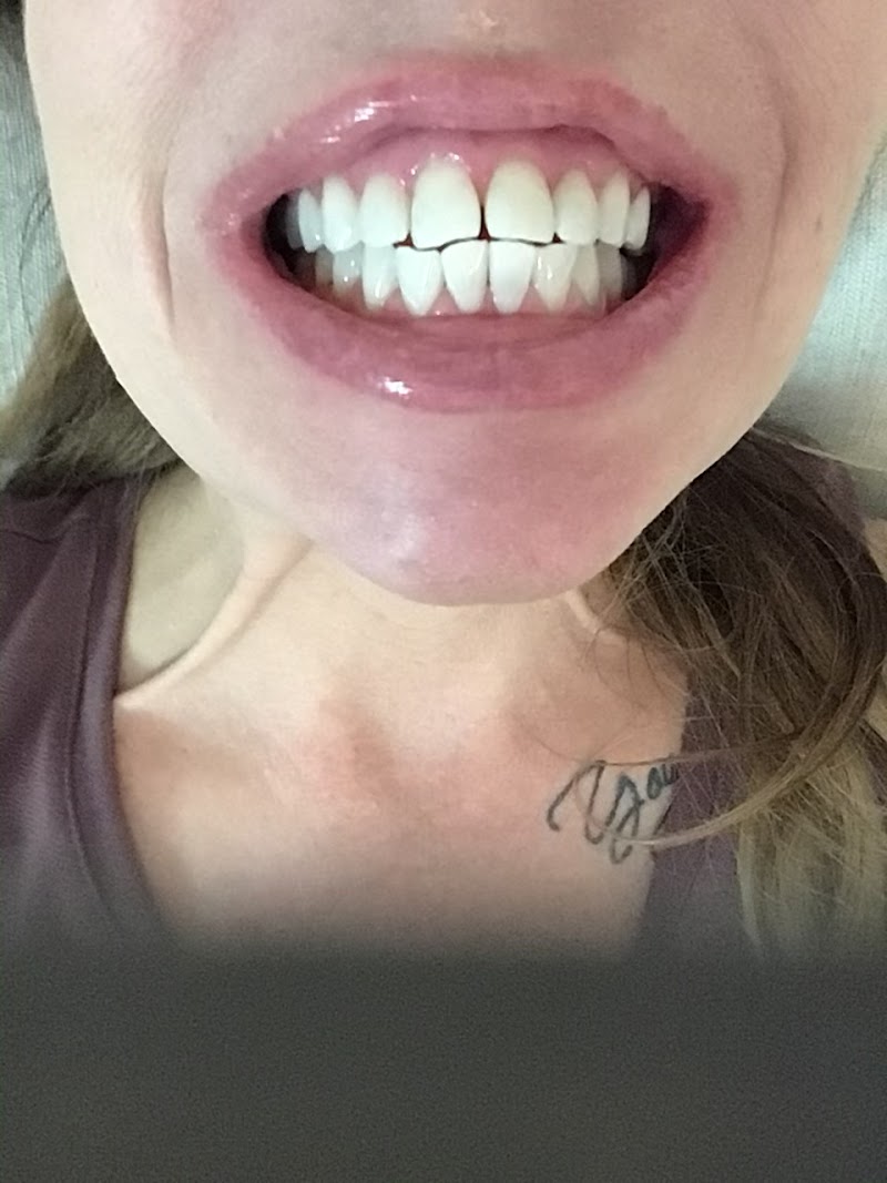 Diamond Shine Professional Teeth Whitening