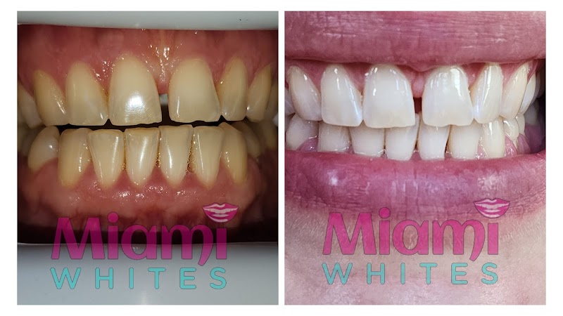 Miami Whites Teeth Whitening