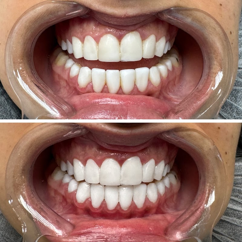 Pure Smiles - Teeth Whitening