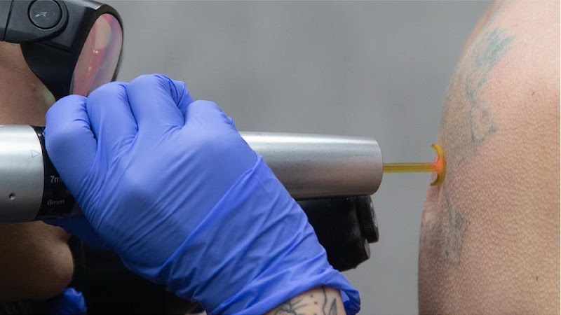 Removery Tattoo Removal & Fading photo 3