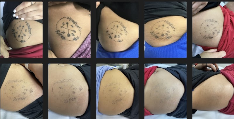 Shipers Laser Tattoo Removal Center Dallas photo 2