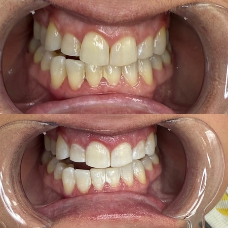 SmileNova Teeth Whitening photo 2